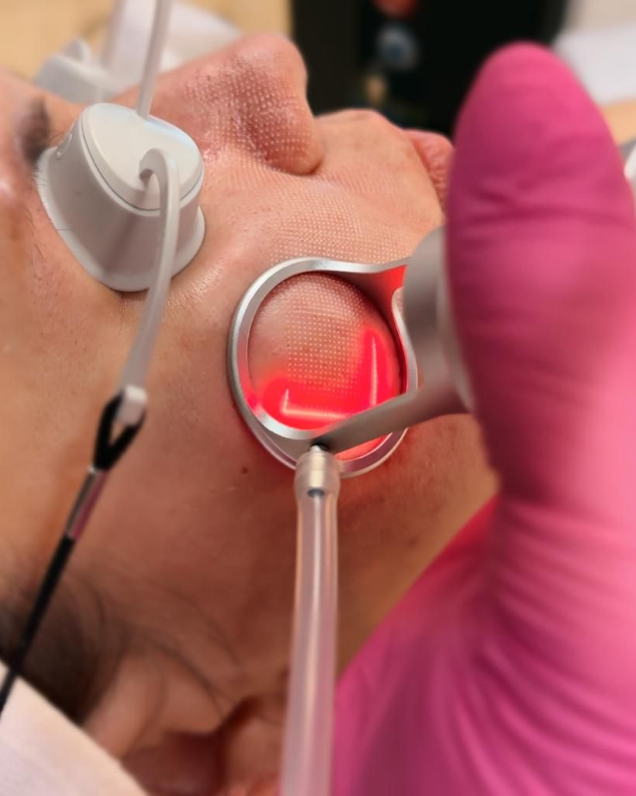 Wynajmę laser frakcyjny C02
